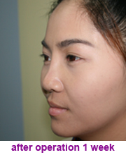 plastic_surgery_augmentation_rhinoplasty